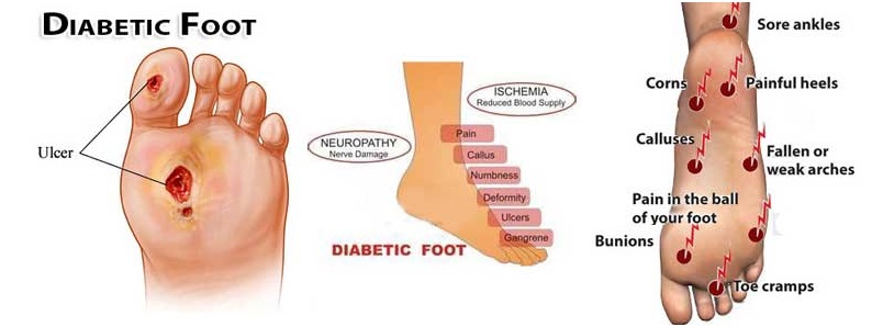 Que desayunar un diabetico